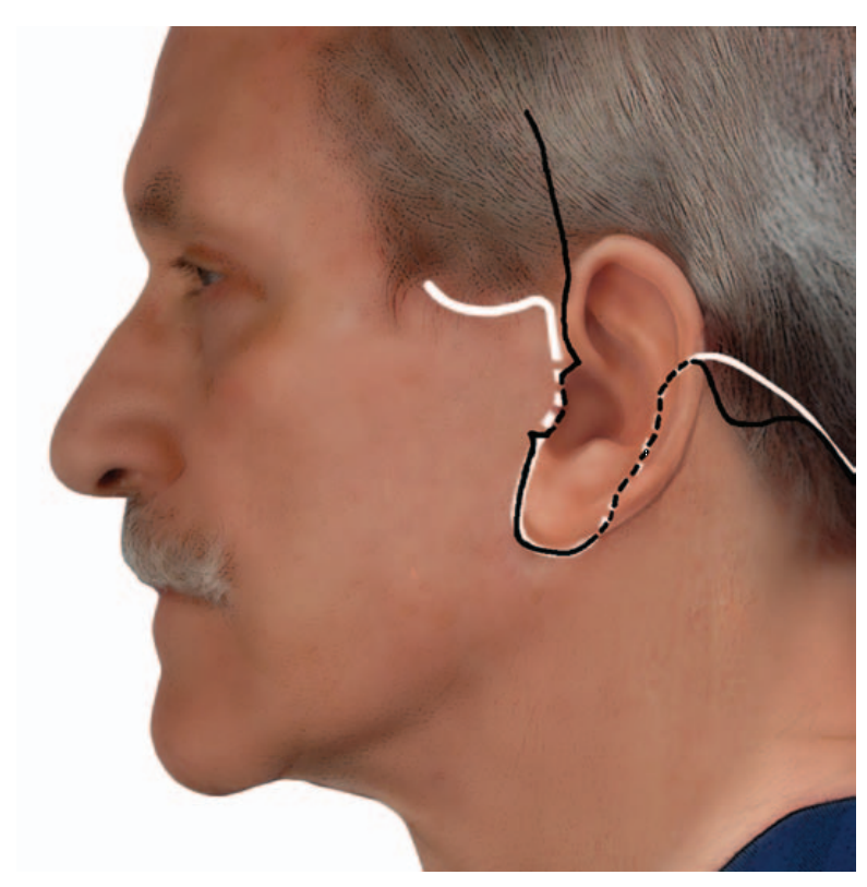 MALE FACELIFT SCARS