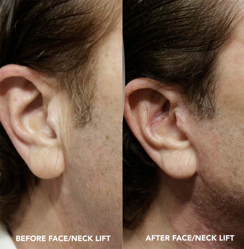 MALE FACELIFT SCARS