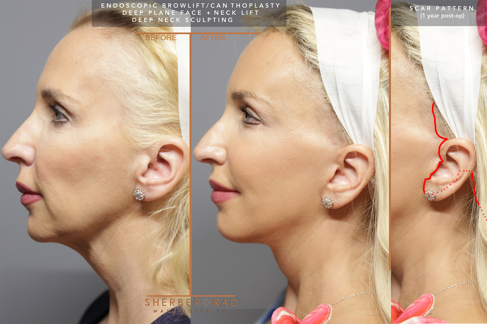 Before and after photos showing facelift scar pattern improvement