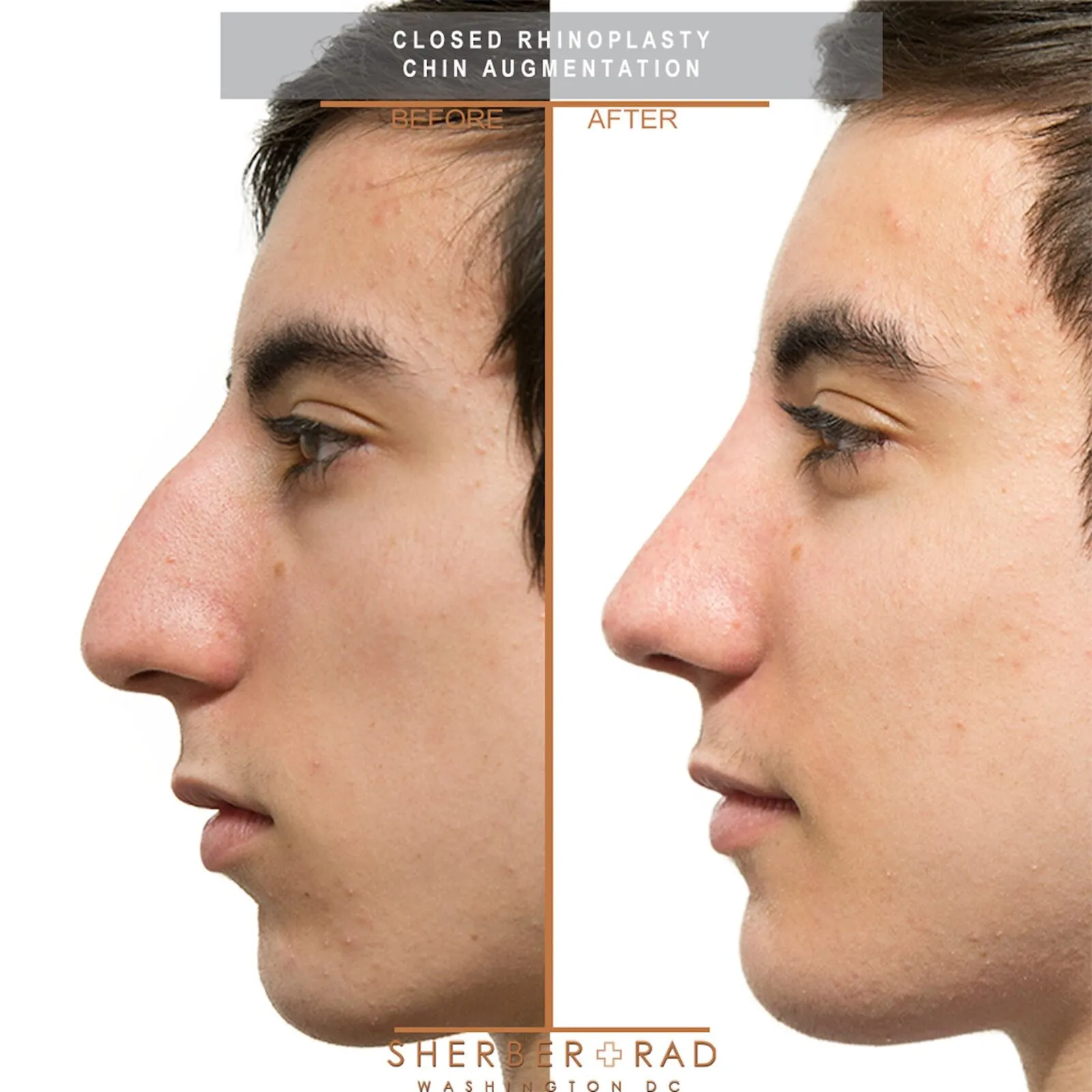 . chin + jaw before and after results