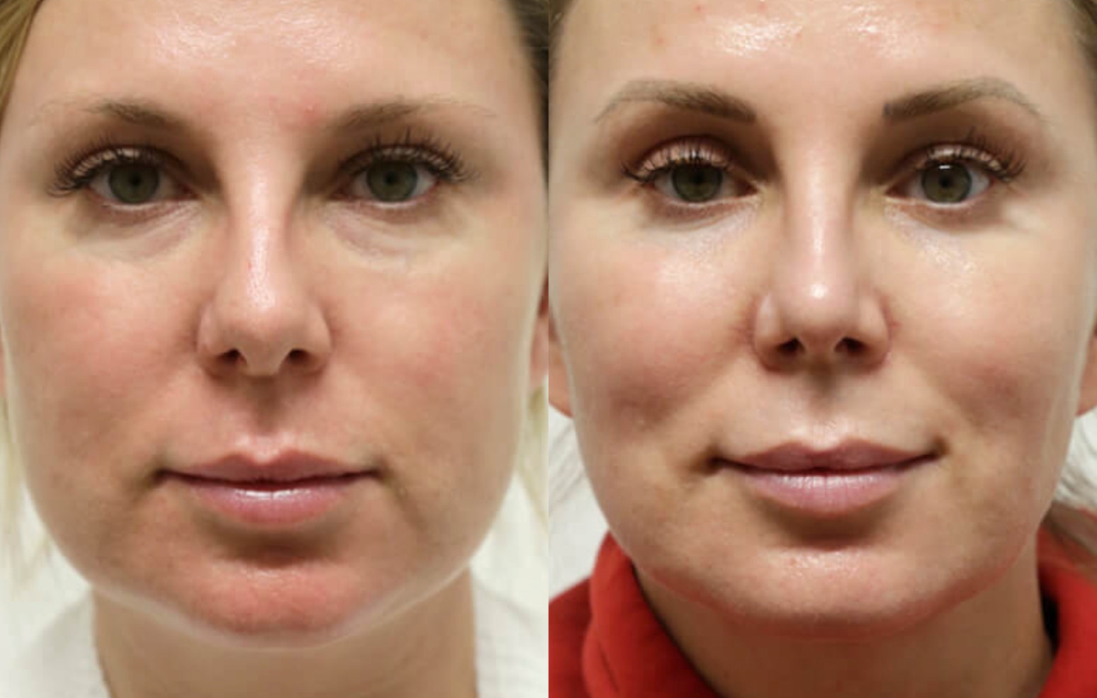 Buccal Fat Removal before and after photos by Sherber and Rad in Washington, DC