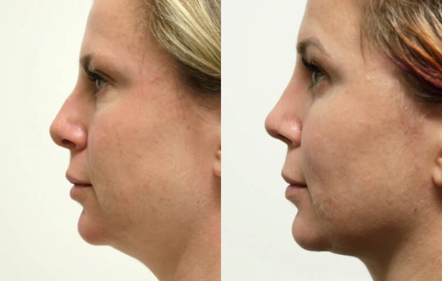 Buccal Fat Removal before and after photos by Sherber and Rad in Washington, DC