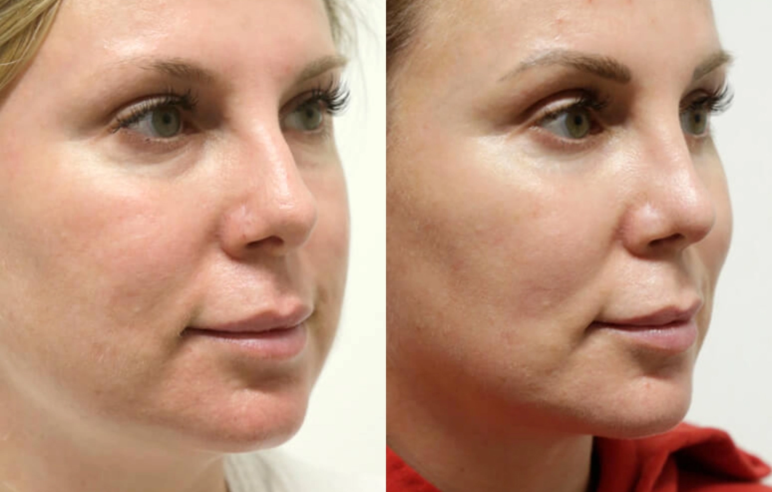 Buccal Fat Removal before and after photos by Sherber and Rad in Washington, DC