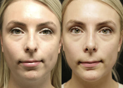 Rhinoplasty before and after photos by Sherber and Rad in Washington, DC