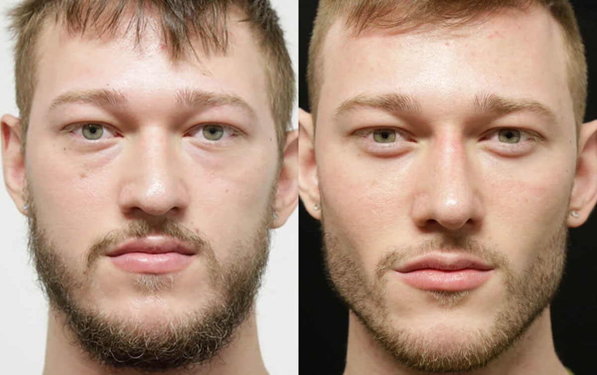 Buccal Fat Removal before and after photos by Sherber and Rad in Washington, DC
