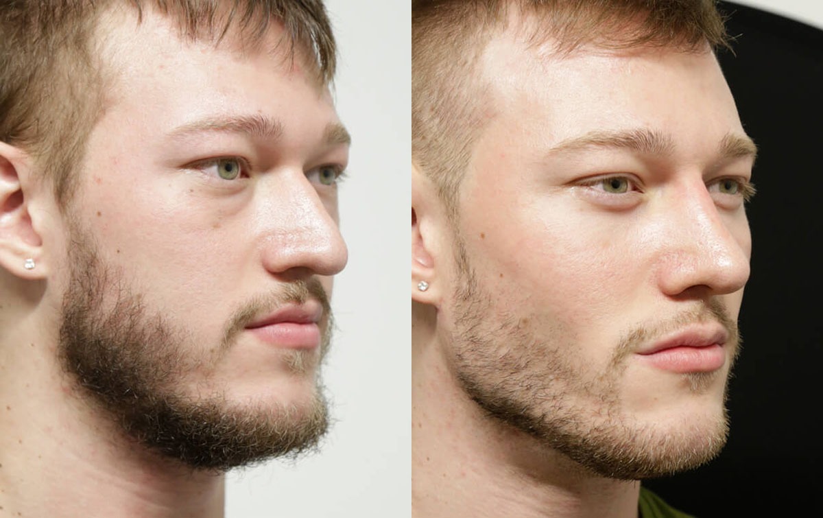 Buccal Fat Removal before and after photos by Sherber and Rad in Washington, DC