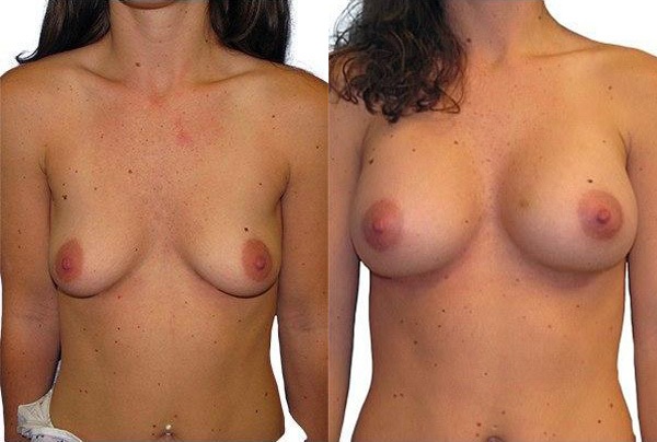 Breast Augmentation before and after photos by Sherber and Rad in Washington, DC
