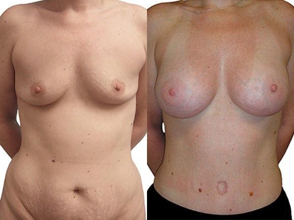Breast Augmentation before and after photos by Sherber and Rad in Washington, DC