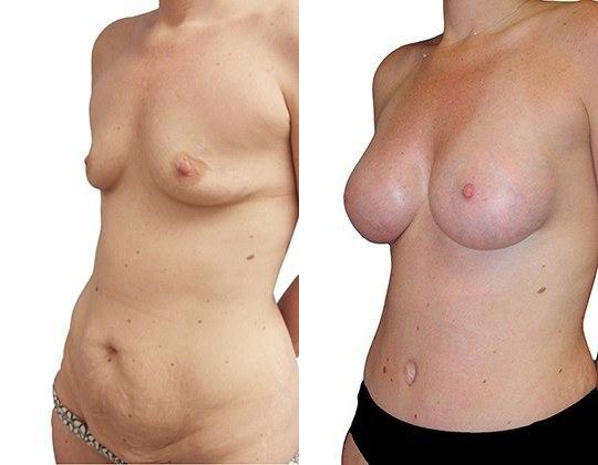 Breast Augmentation before and after photos by Sherber and Rad in Washington, DC
