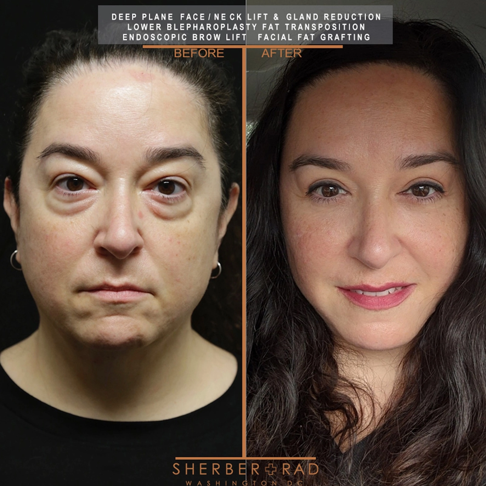 . eyes before and after results