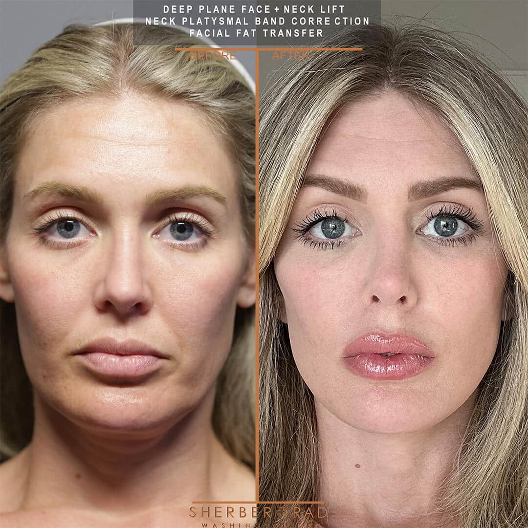 Deep Plane Facelift before and after photos by Sherber and Rad in Washington