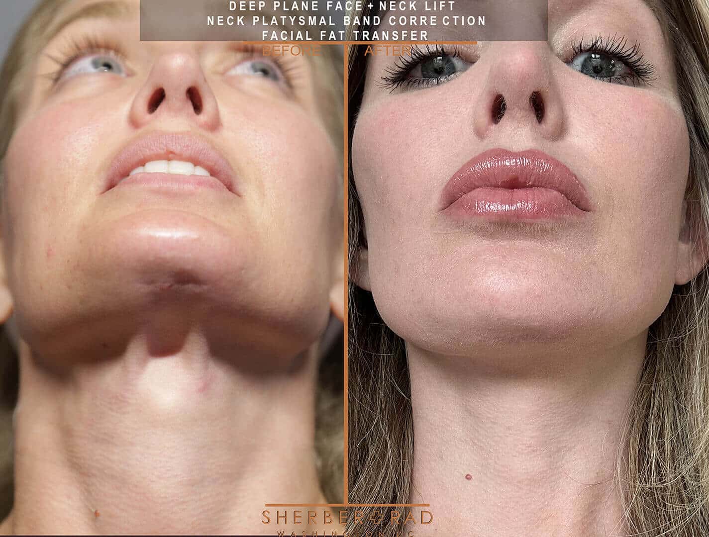 Deep Plane Facelift before and after photos by Sherber and Rad in Washington