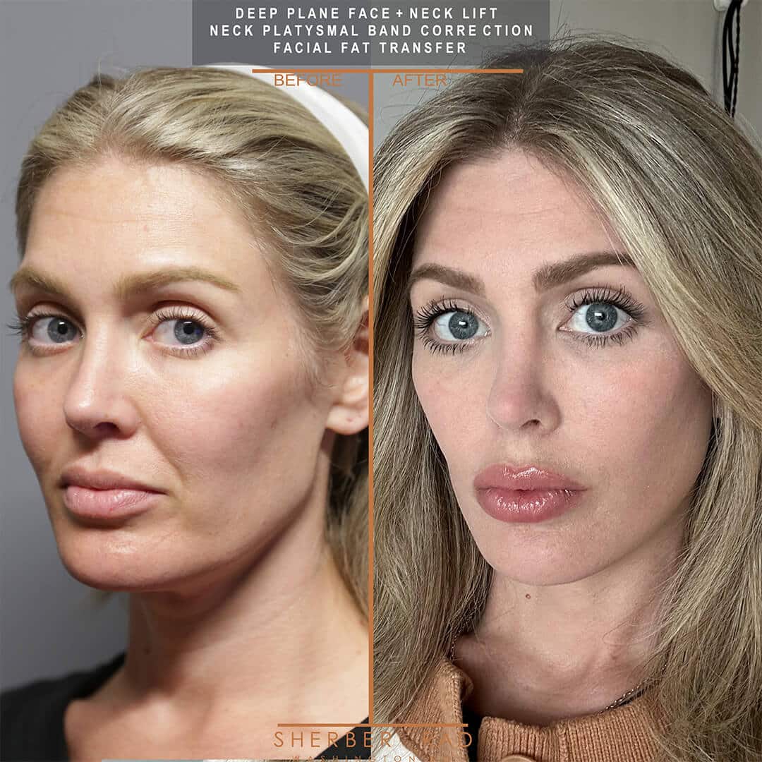 Deep Plane Facelift before and after photos by Sherber and Rad in Washington