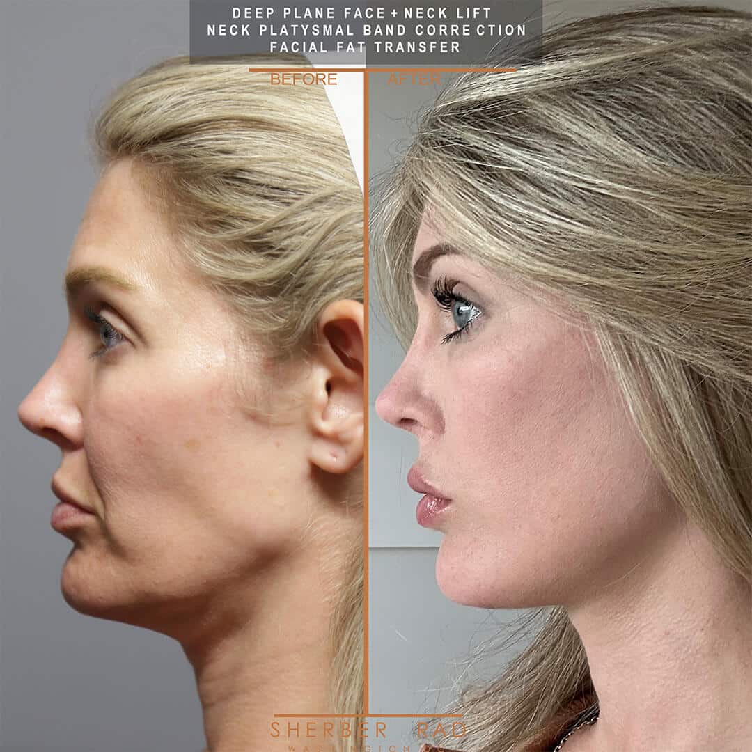 Deep Plane Facelift before and after photos by Sherber and Rad in Washington