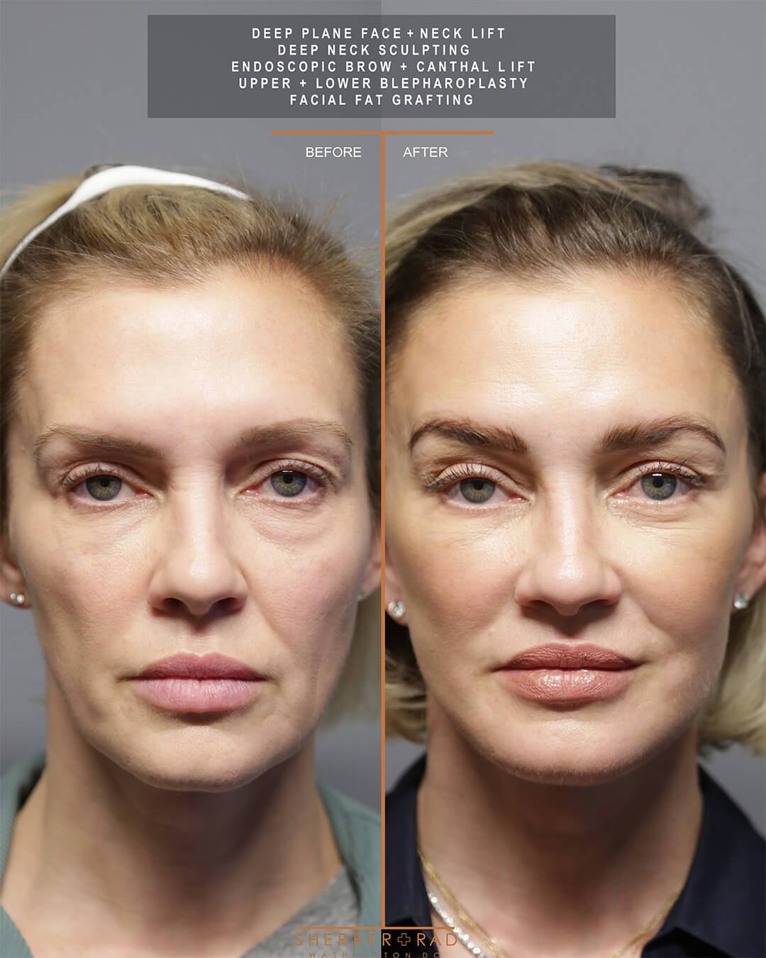 deep plane facelift before and after photos by sherber and rad in washington dc