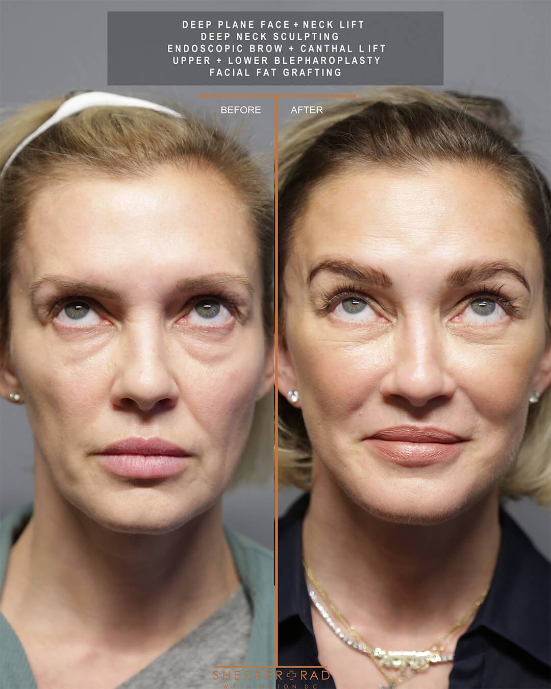 deep plane facelift before and after photos by sherber and rad in washington dc