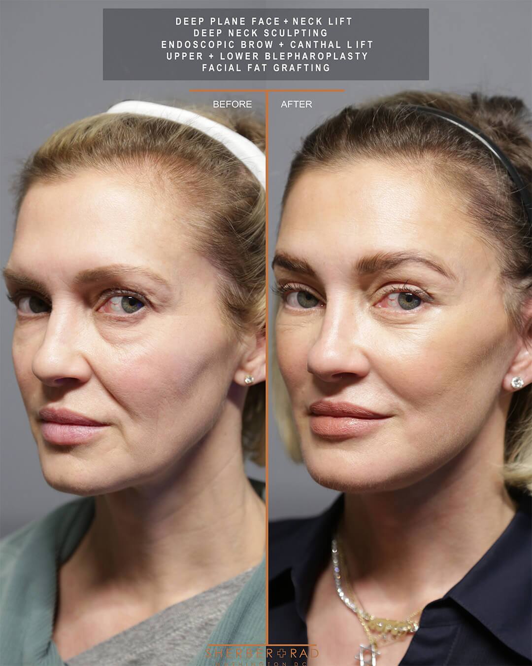 deep plane facelift before and after photos by sherber and rad in washington dc