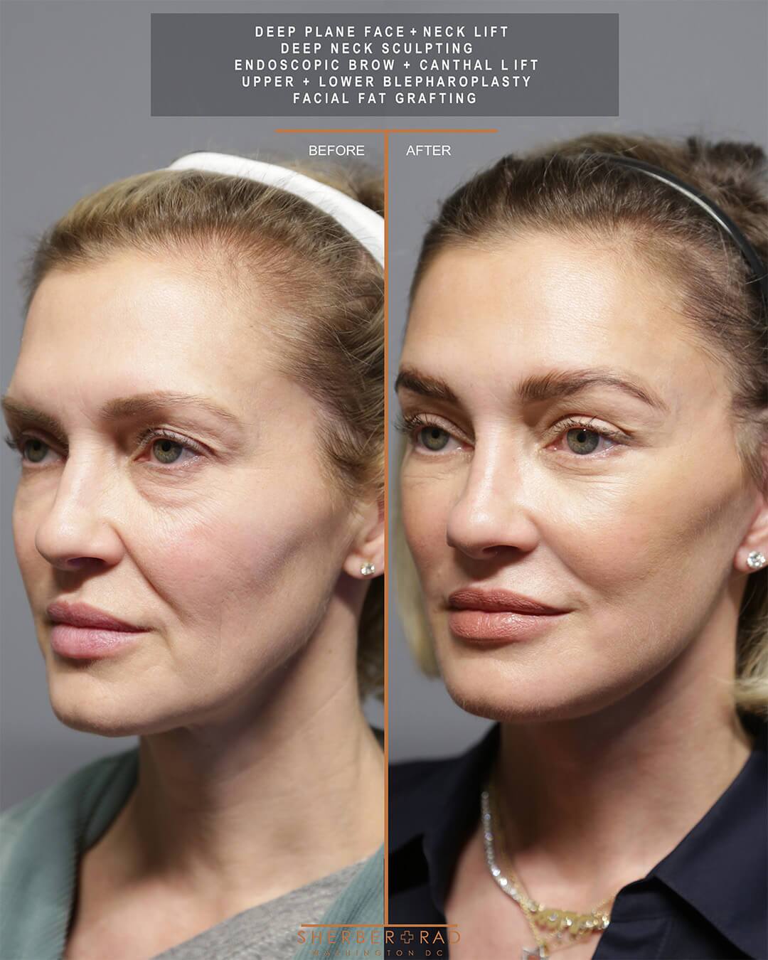 deep plane facelift before and after photos by sherber and rad in washington dc