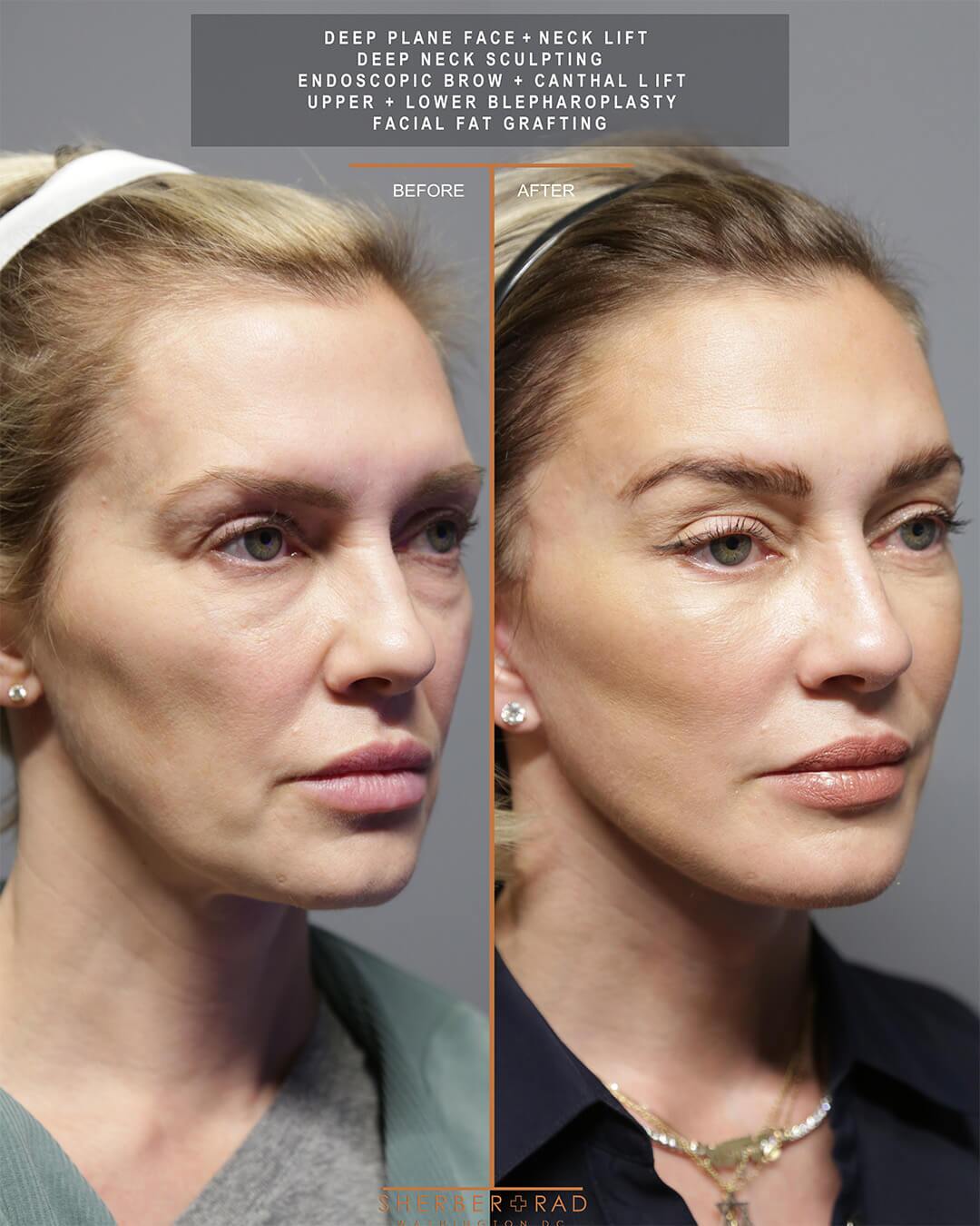 deep plane facelift before and after photos by sherber and rad in washington dc