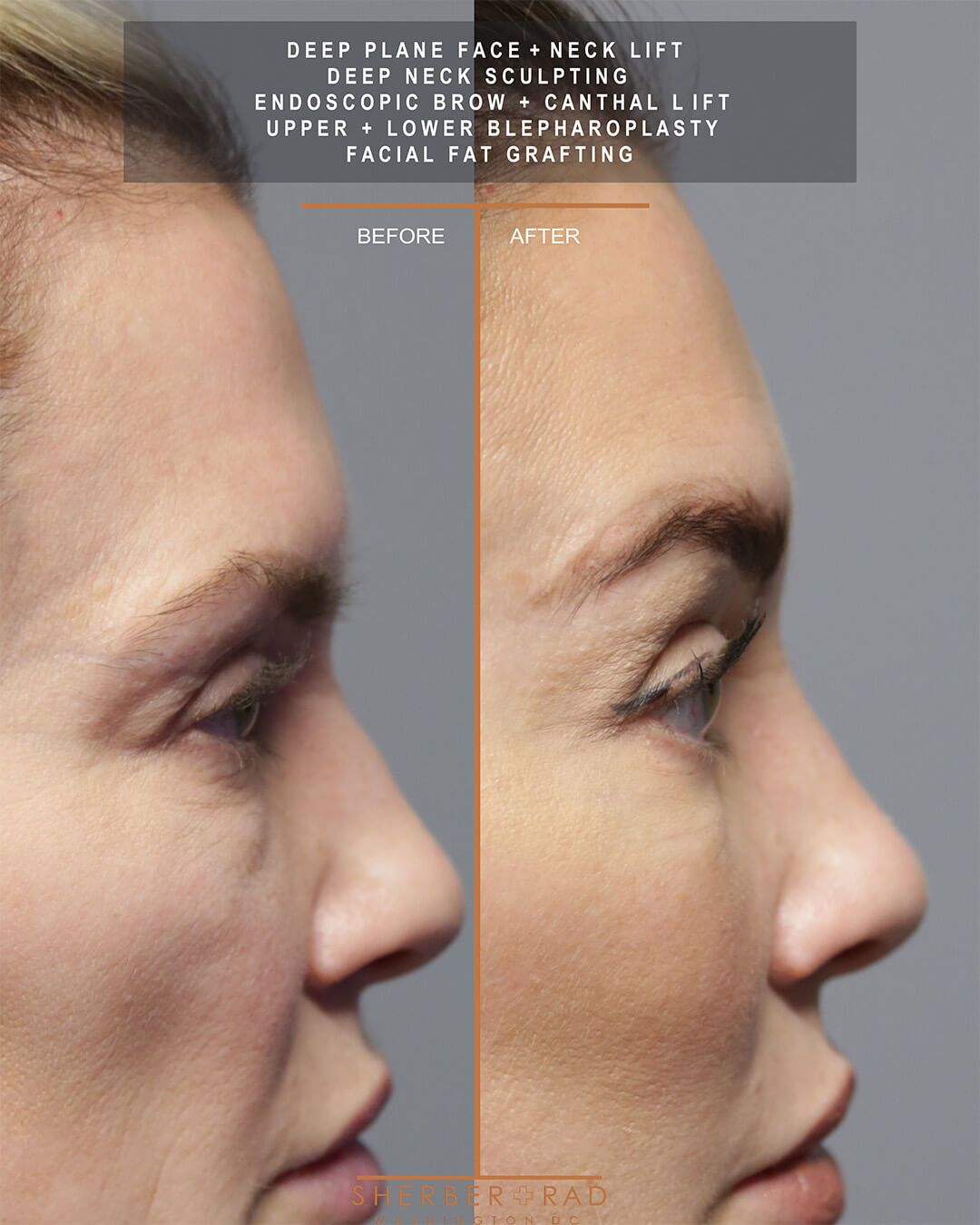 deep plane facelift before and after photos by sherber and rad in washington dc
