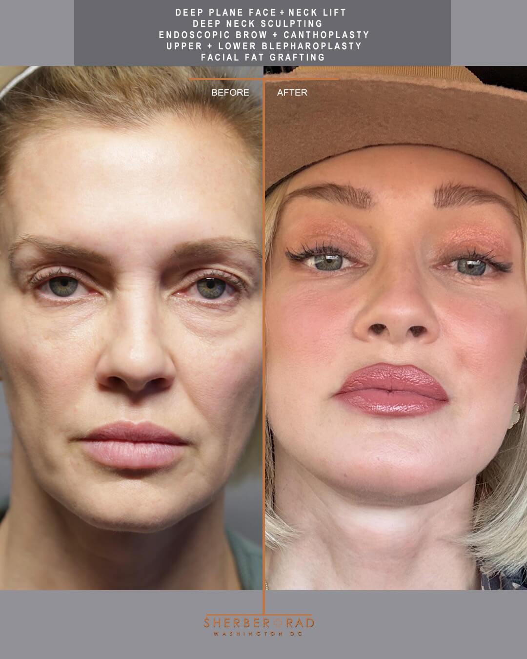 deep plane facelift before and after photos by sherber and rad in washington dc