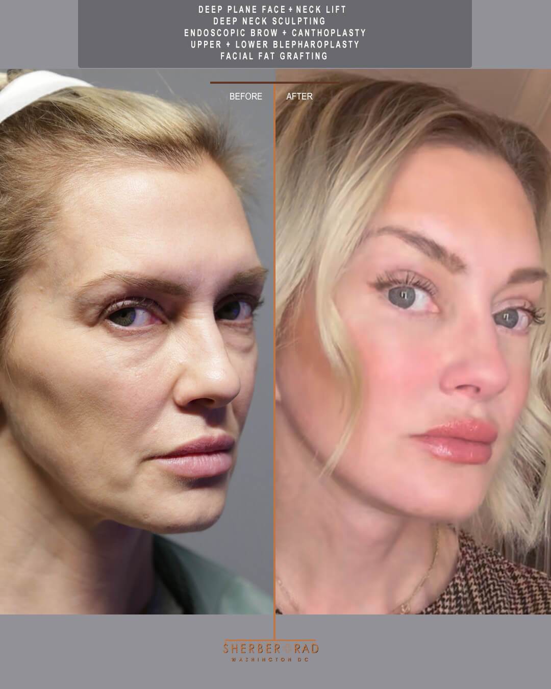 deep plane facelift before and after photos by sherber and rad in washington dc