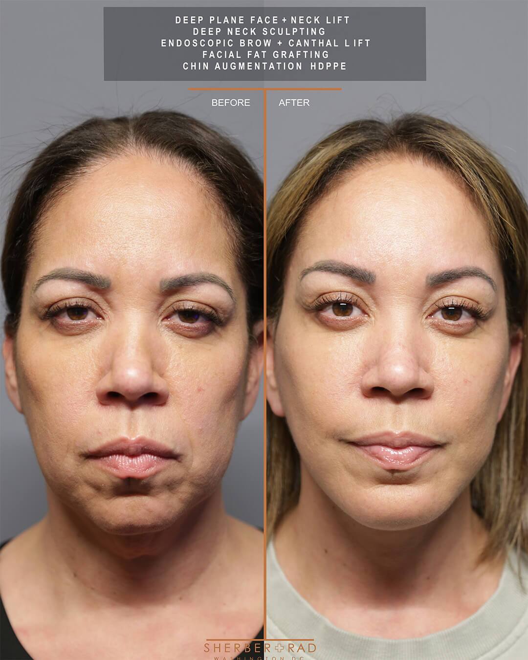 deep plane facelift before and after photos by sherber and rad in washington dc