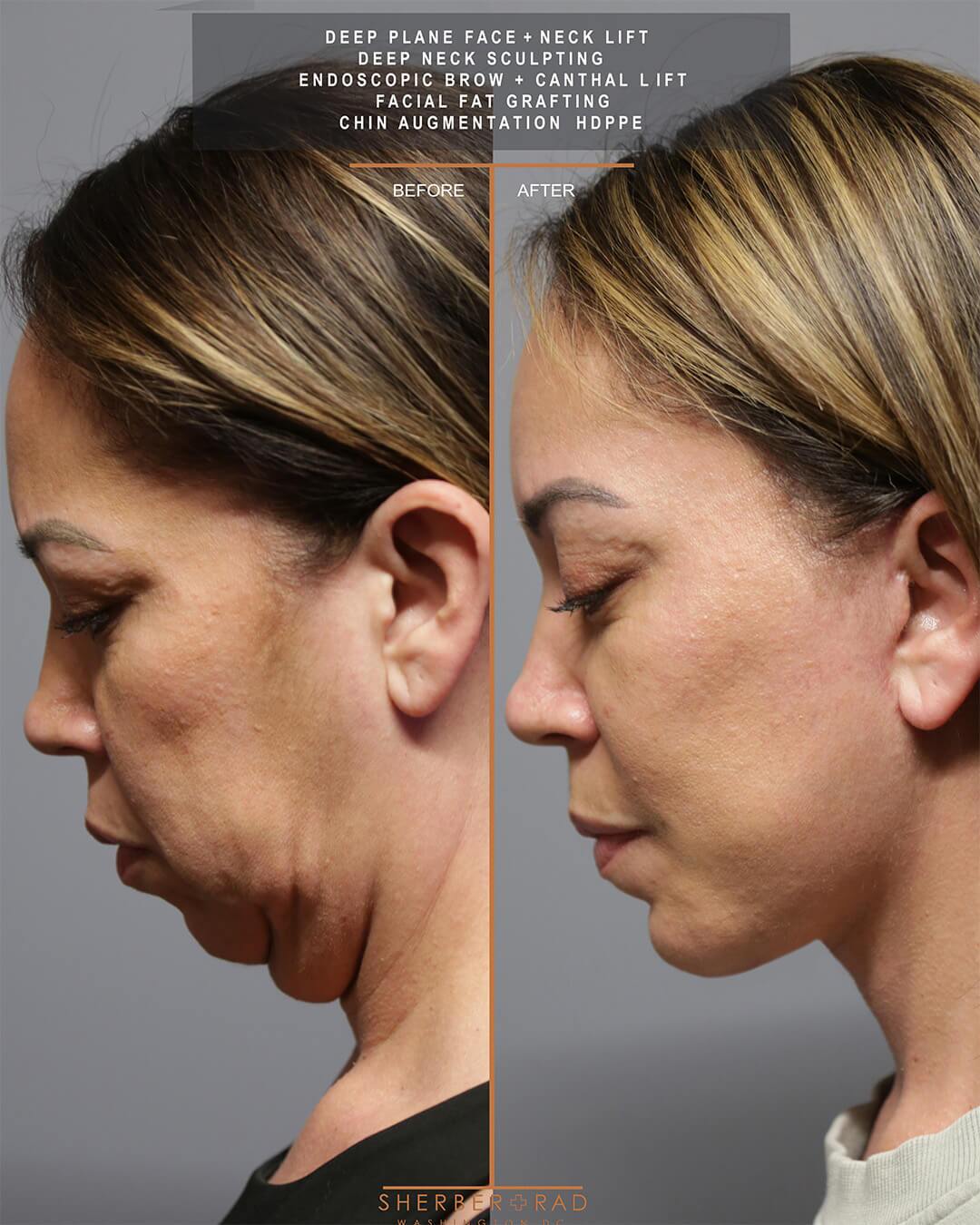 deep plane facelift before and after photos by sherber and rad in washington dc