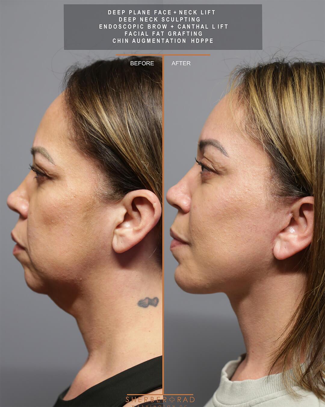 deep plane facelift before and after photos by sherber and rad in washington dc