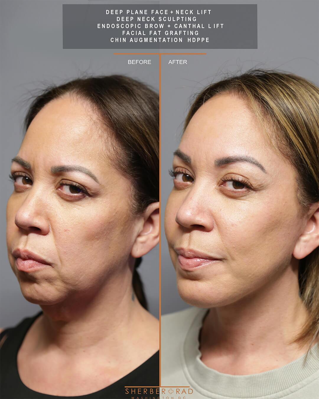 deep plane facelift before and after photos by sherber and rad in washington dc