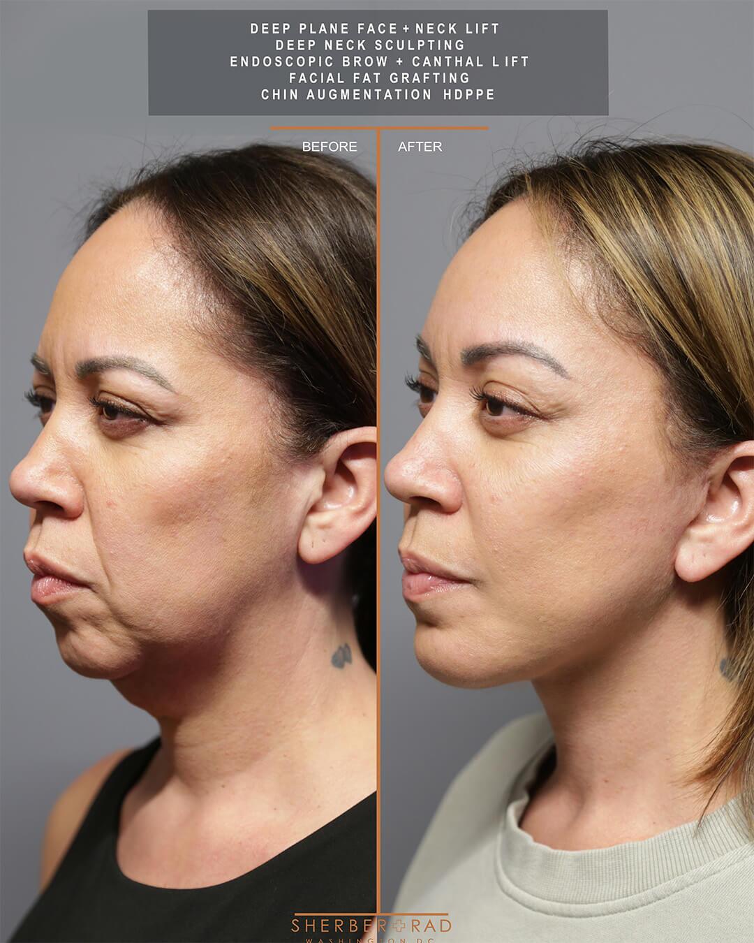 deep plane facelift before and after photos by sherber and rad in washington dc