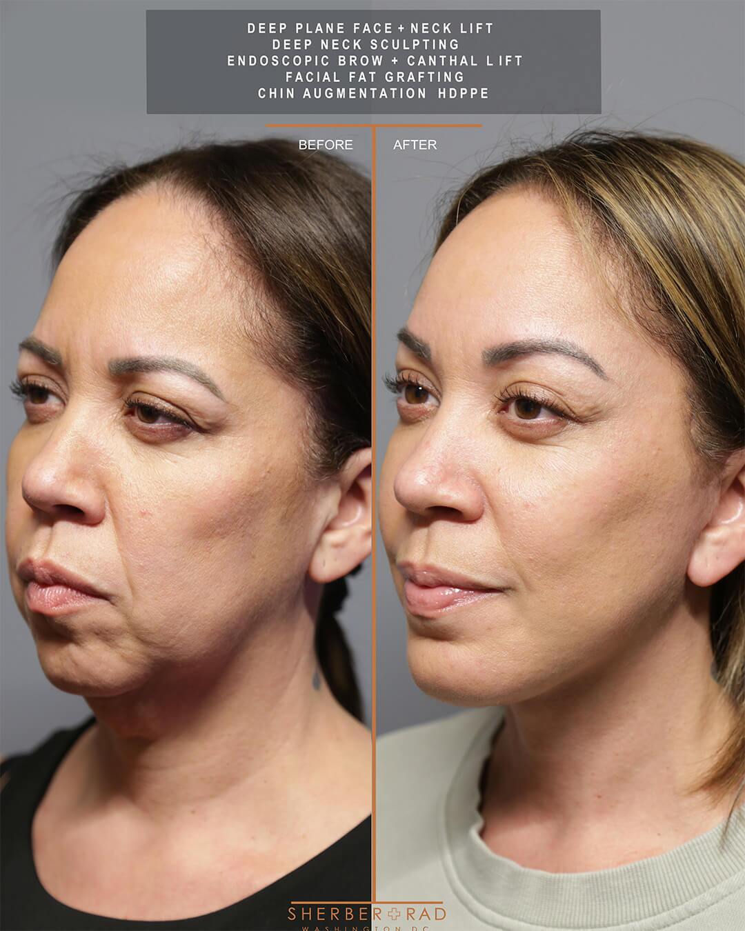 deep plane facelift before and after photos by sherber and rad in washington dc