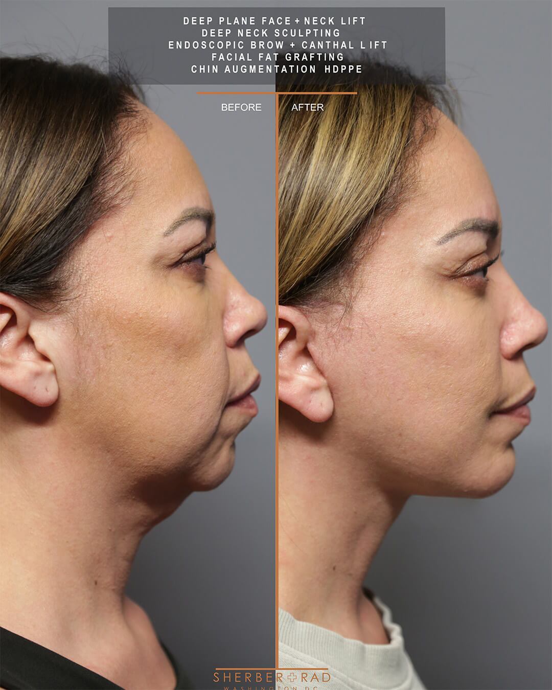 deep plane facelift before and after photos by sherber and rad in washington dc