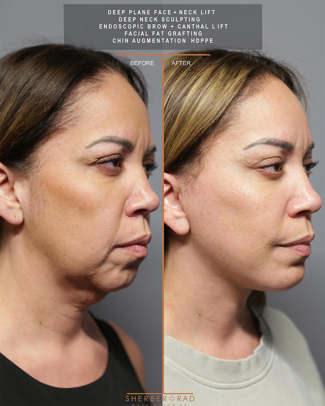deep plane facelift before and after photos by sherber and rad in washington dc