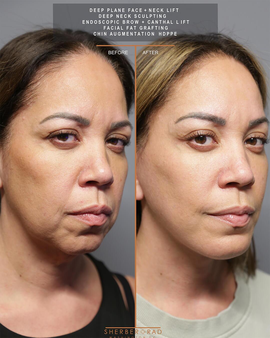 deep plane facelift before and after photos by sherber and rad in washington dc