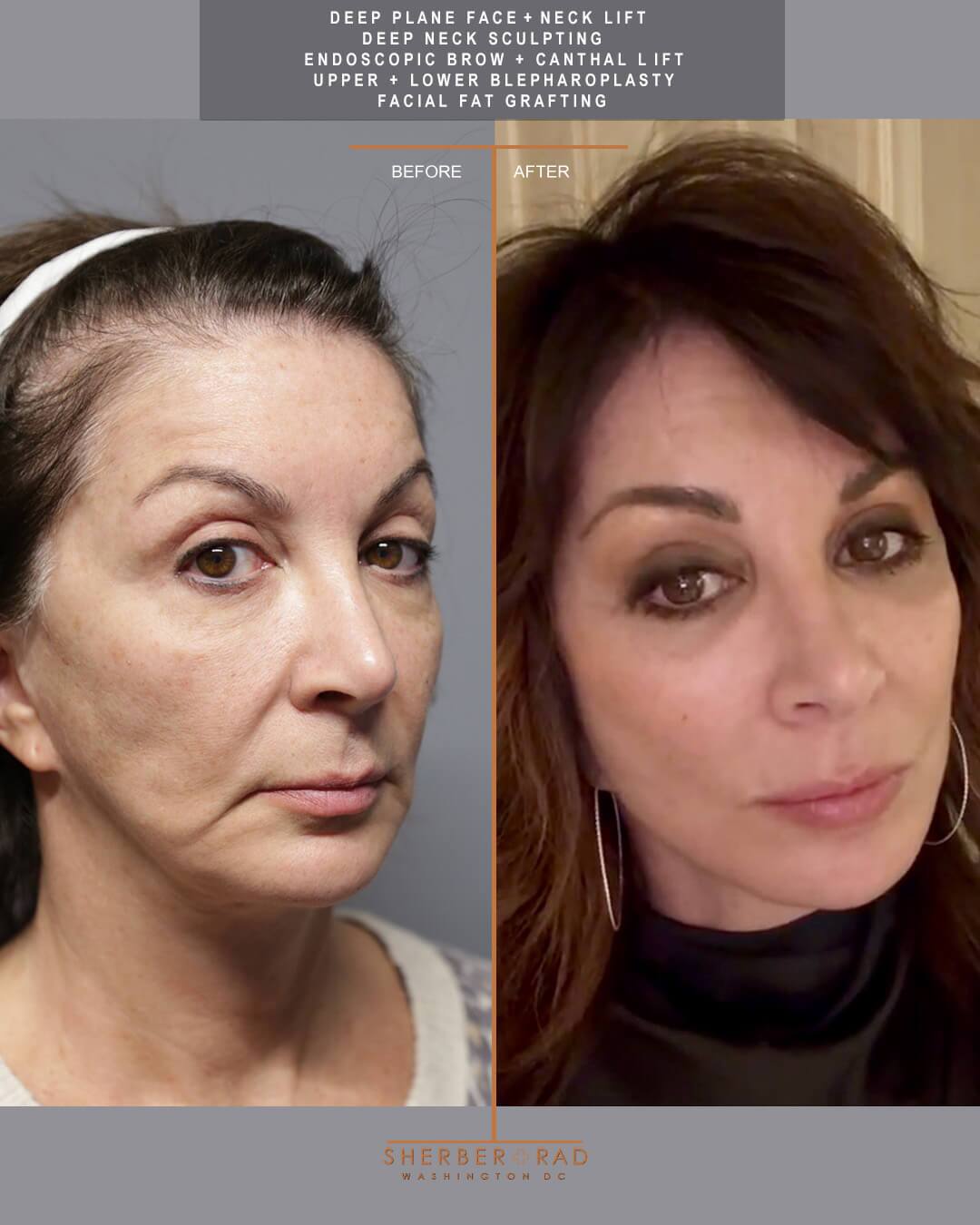 deep plane facelift before and after photos by sherber and rad in washington dc