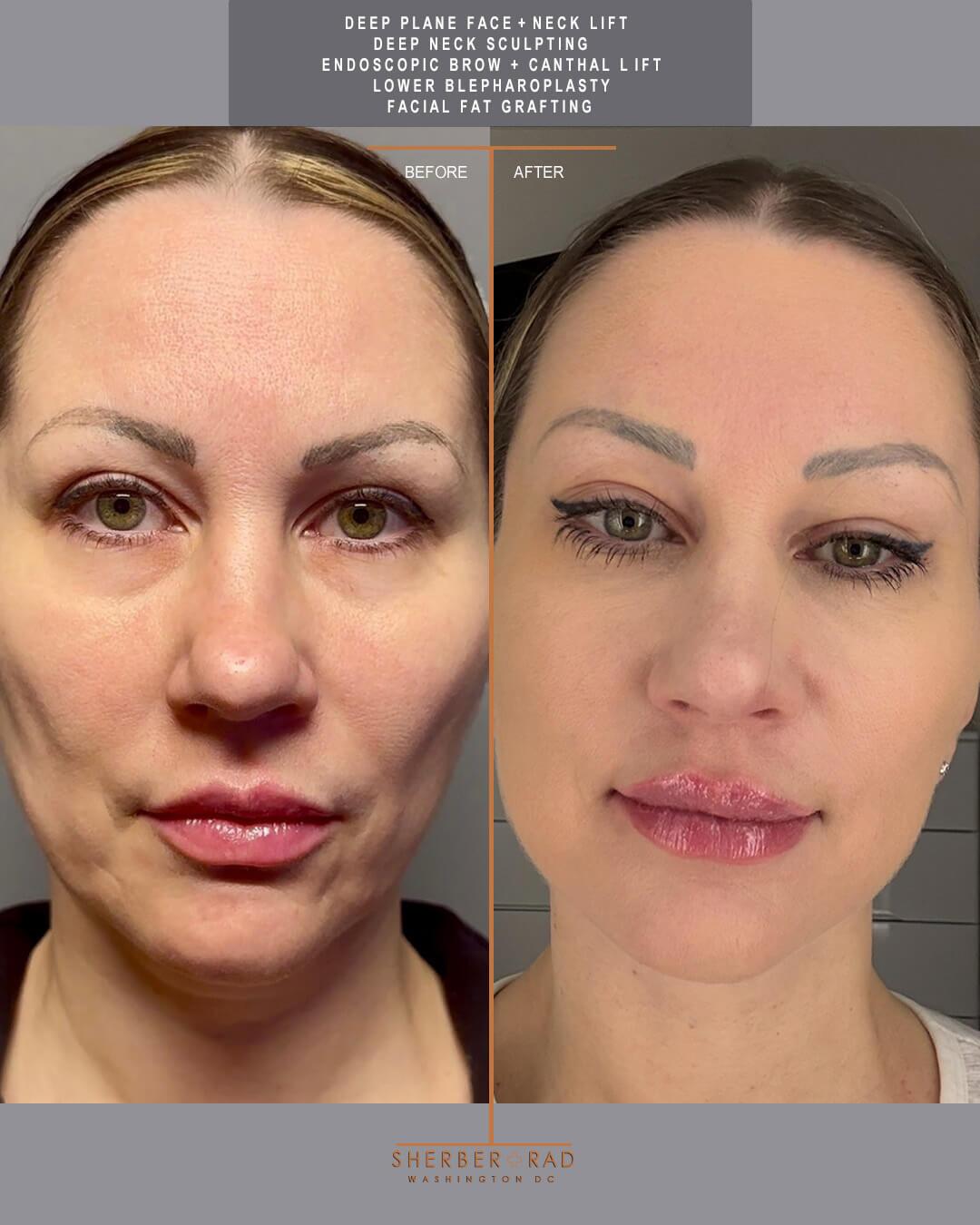 deep plane facelift before and after photos by sherber and rad in washington dc