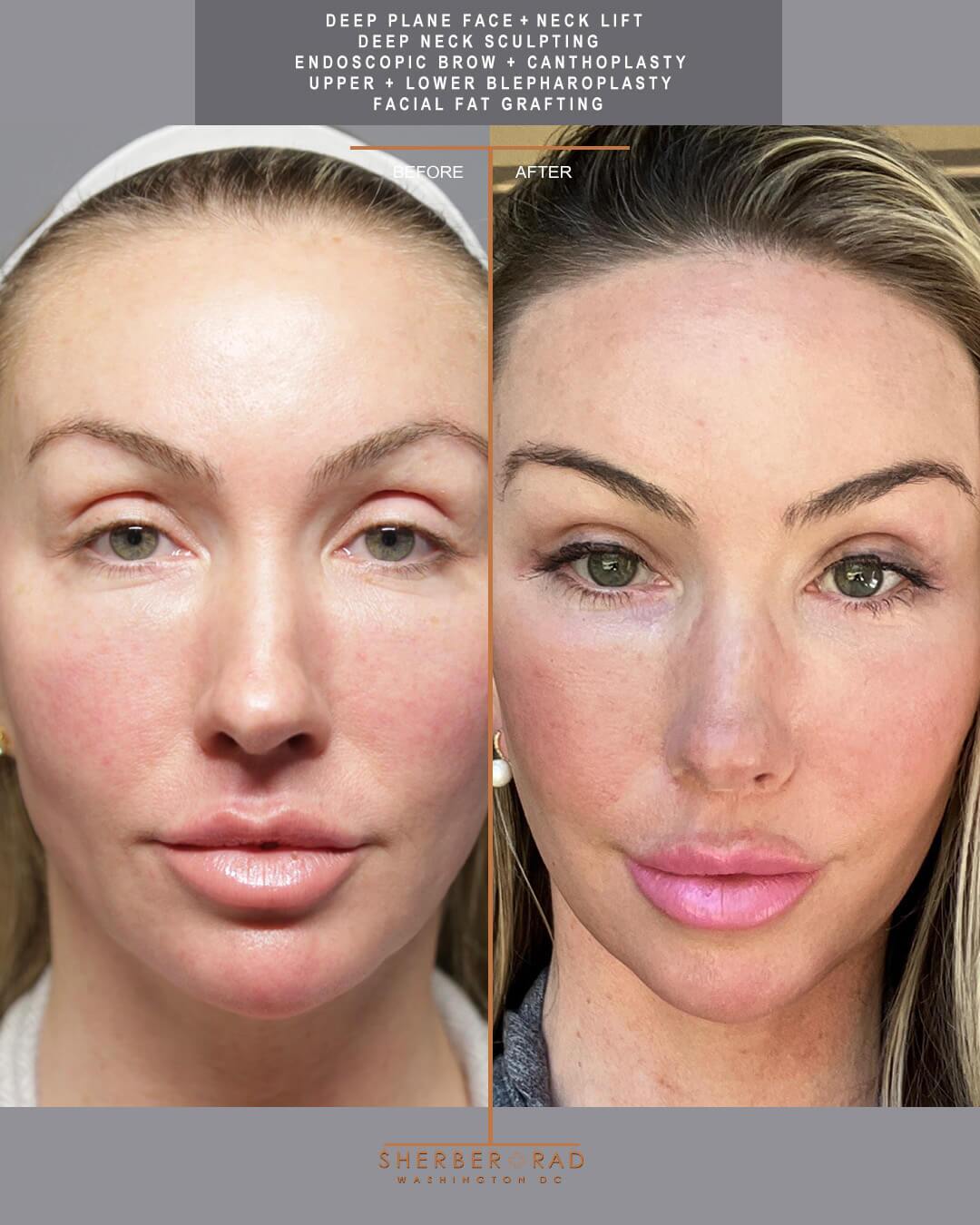 deep plane facelift before and after photos by sherber and rad in washington dc