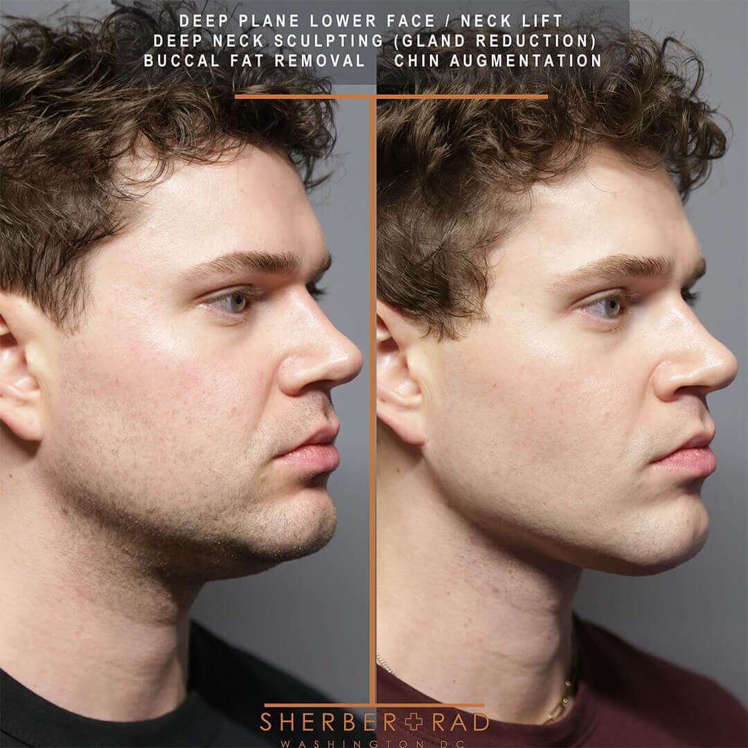 male facelift before and after photos by sherber and rad in washington dc