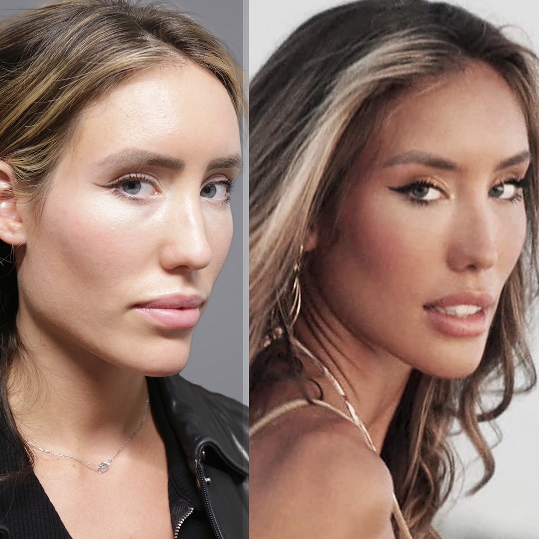 Jaw Reduction before and after photos by Sherber and Rad in Washington DC