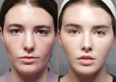 Jaw Reduction before and after photos by Sherber and Rad in Washington DC