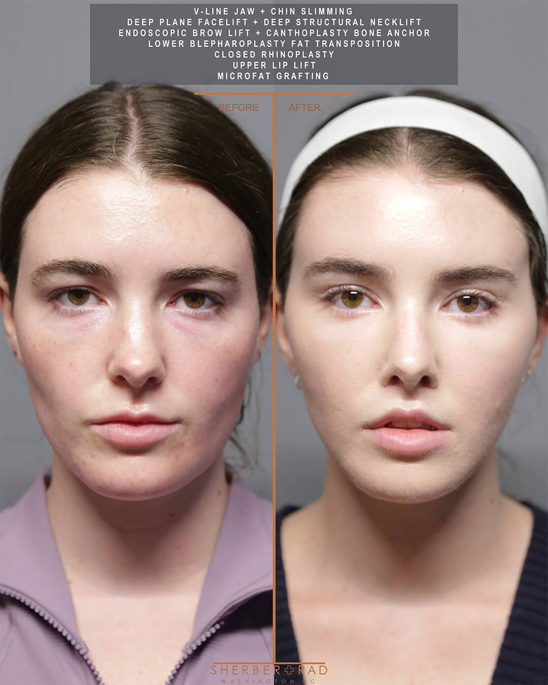 Jaw Reduction before and after photos by Sherber and Rad in Washington DC