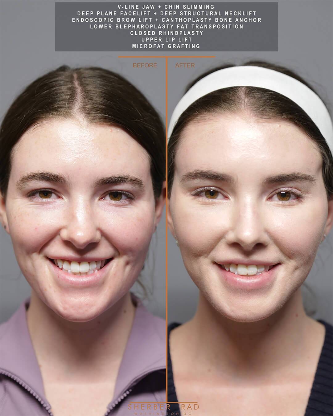 Jaw Reduction before and after photos by Sherber and Rad in Washington DC