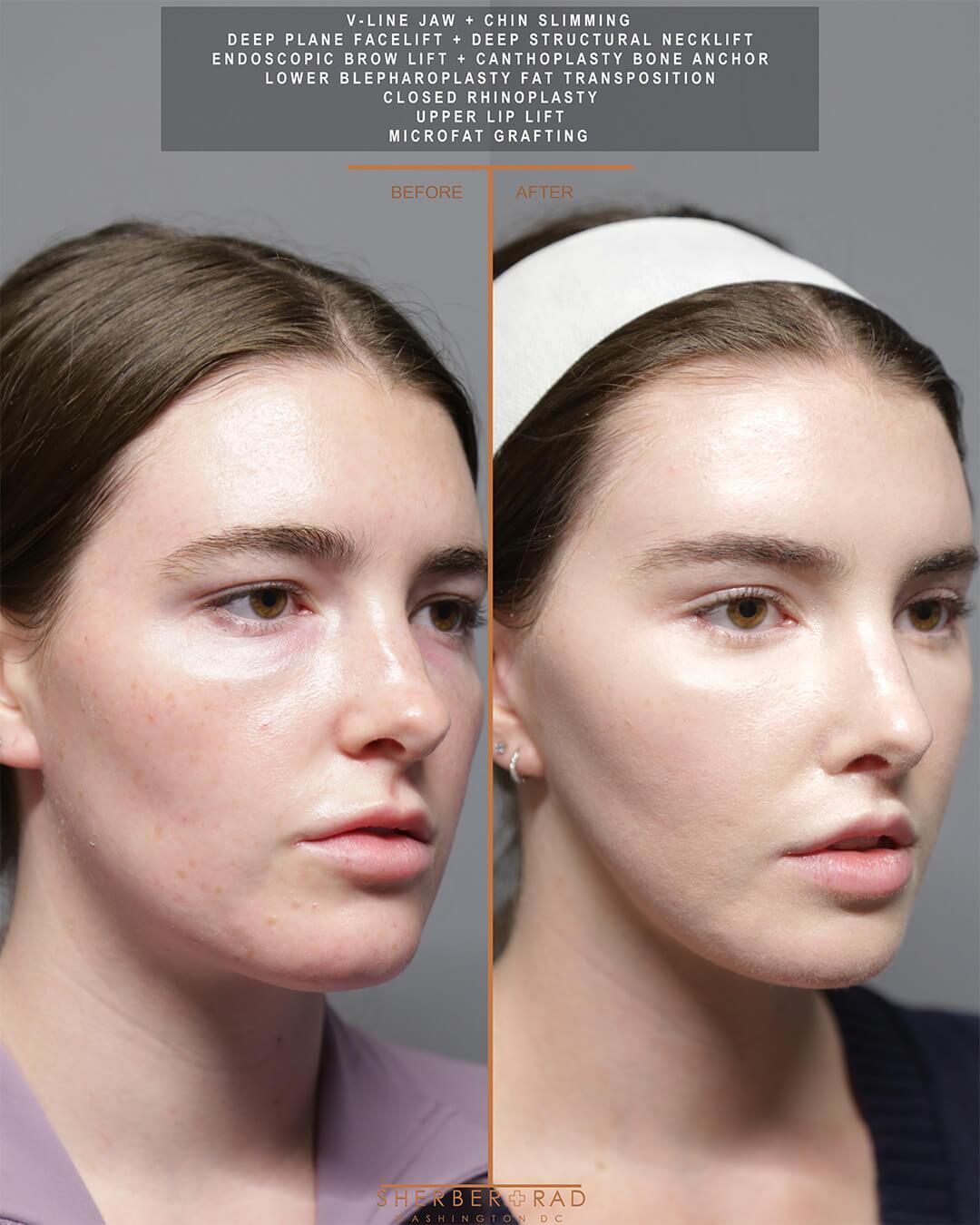 Jaw Reduction before and after photos by Sherber and Rad in Washington DC