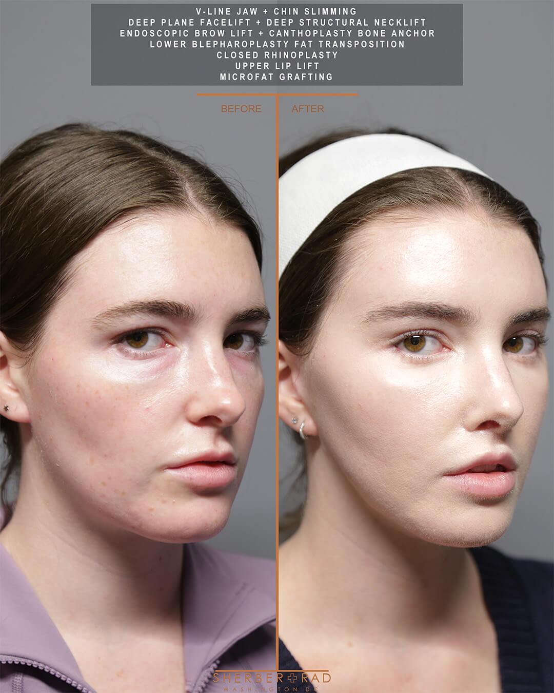 Jaw Reduction before and after photos by Sherber and Rad in Washington DC