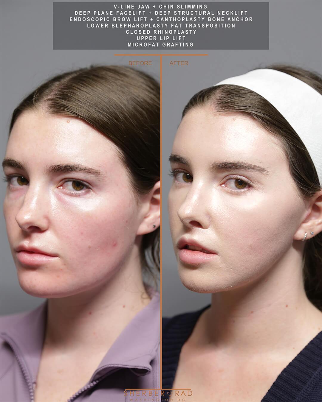 Jaw Reduction before and after photos by Sherber and Rad in Washington DC