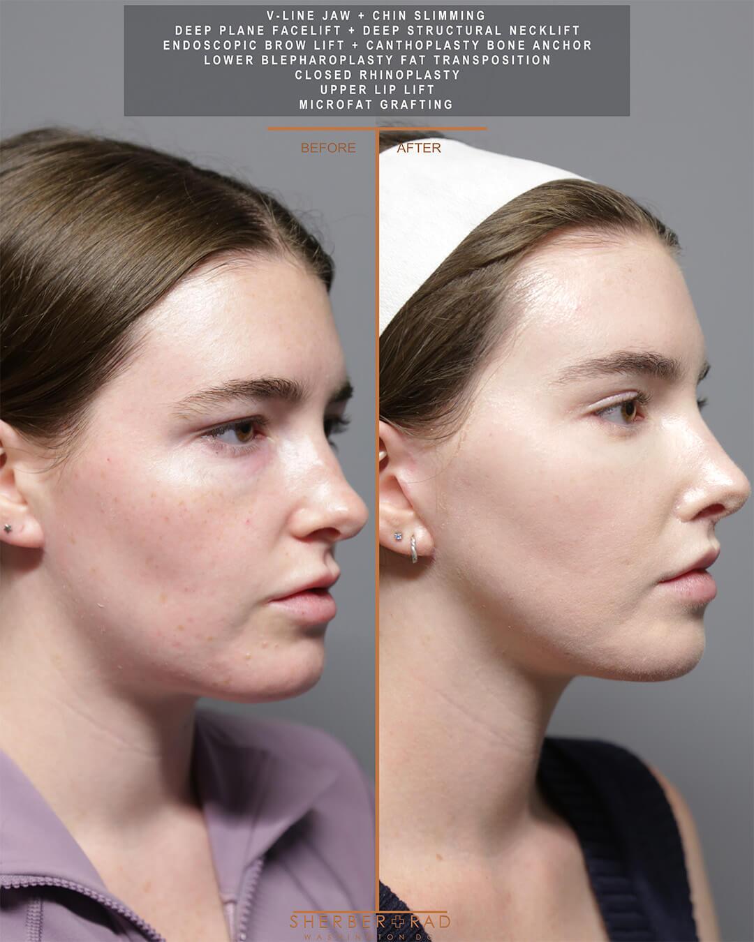 Jaw Reduction before and after photos by Sherber and Rad in Washington DC