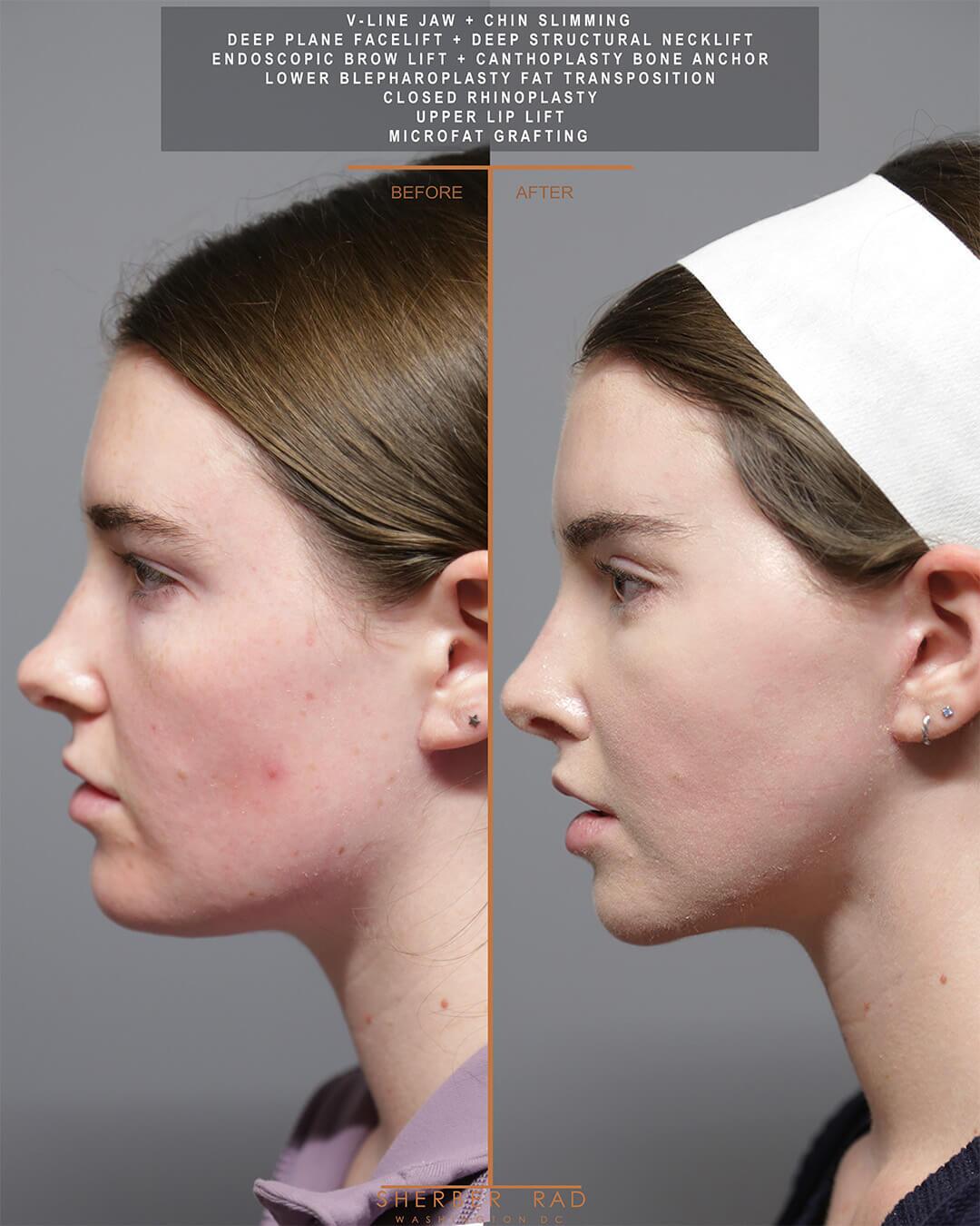 Jaw Reduction before and after photos by Sherber and Rad in Washington DC