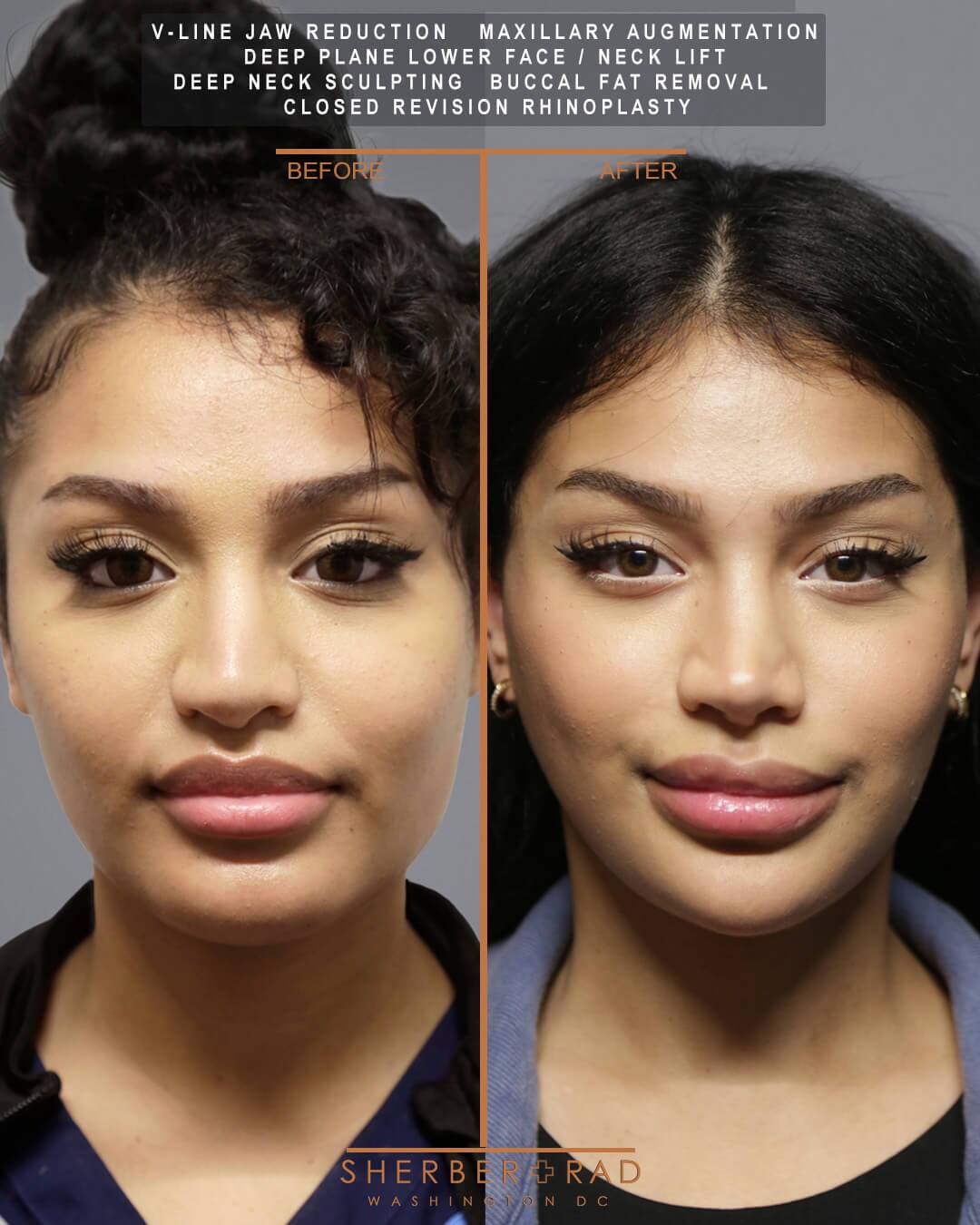 Jaw Reduction before and after photos by Sherber and Rad in Washington DC