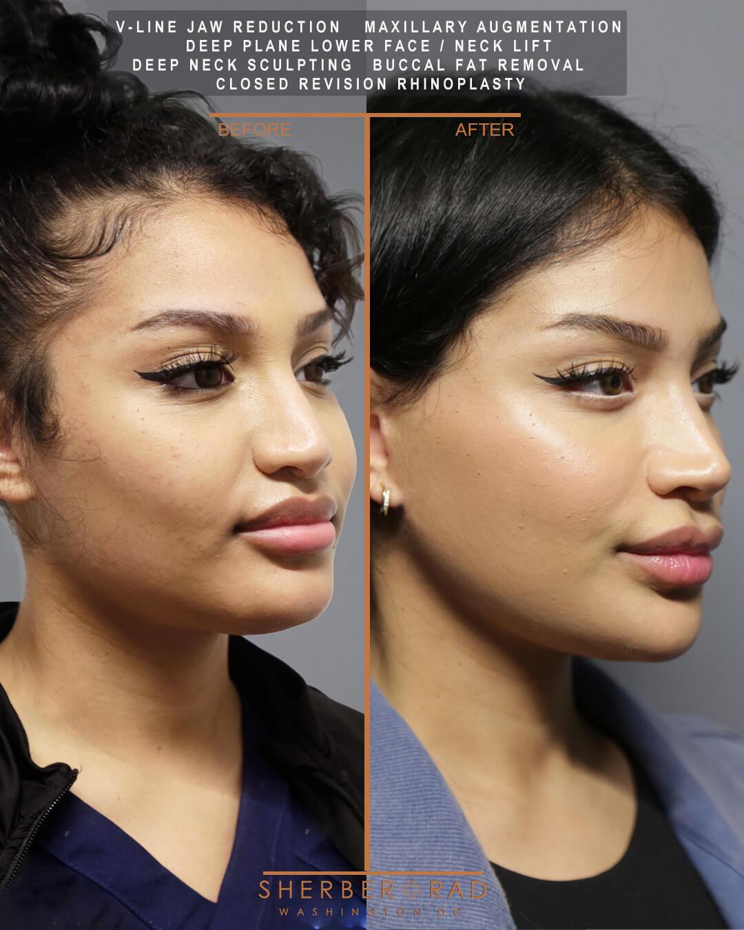 Jaw Reduction before and after photos by Sherber and Rad in Washington DC